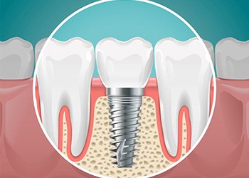 Illustration showing dental implant in jawbone